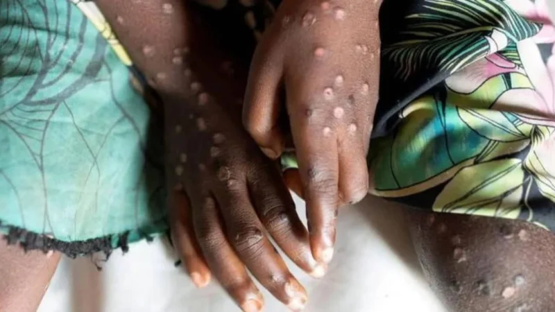 Mpox Spike in Ashanti And Tolls High Recordings