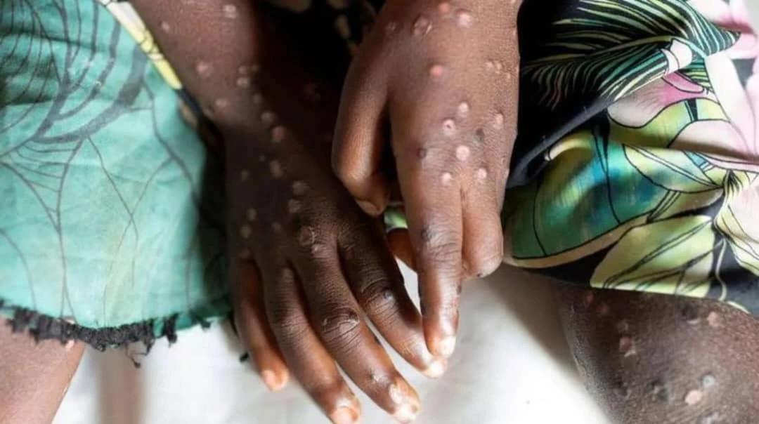 MPOX DISEASE